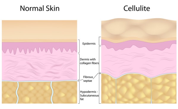 Cellulite image