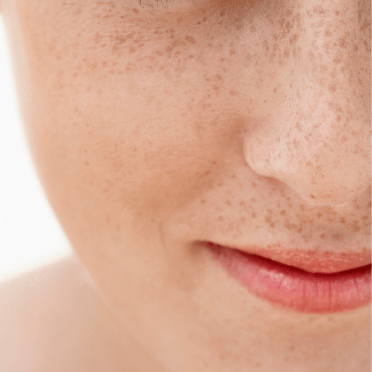 freckles removal