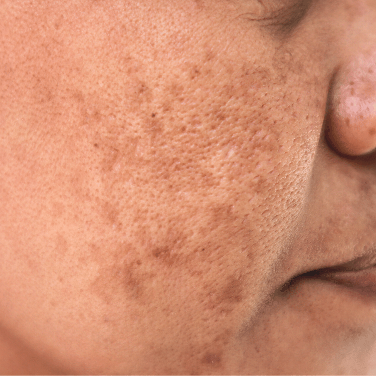 melasma pigmentation